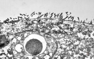 jejunum - celiakia jejunum - celiakia